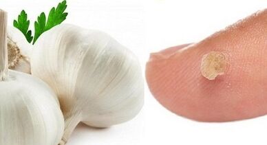 лечение на брадавици с народни средства