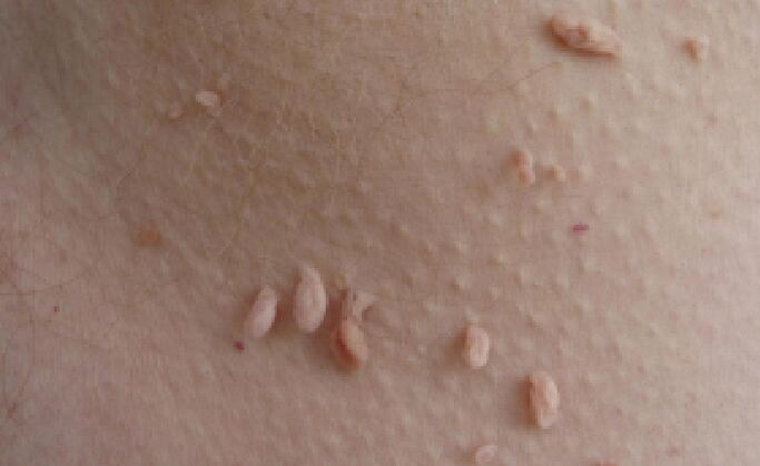 причини за появата на папиломи върху човешкото тяло