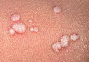 вулгарни папиломи по човешкото тяло