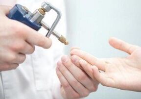 съвременни методи за премахване на папиломи