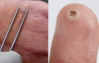 симптоми на папиломи по човешкото тяло