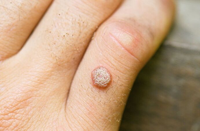 При заразяване с HPV може да се появи брадавица на ръката или друга част на тялото